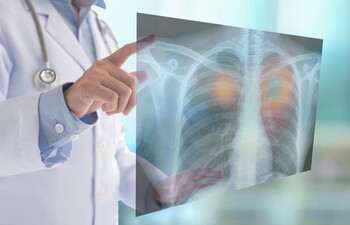 Un fármaco eleva la supervivencia en tumores de pulmón en un 20%